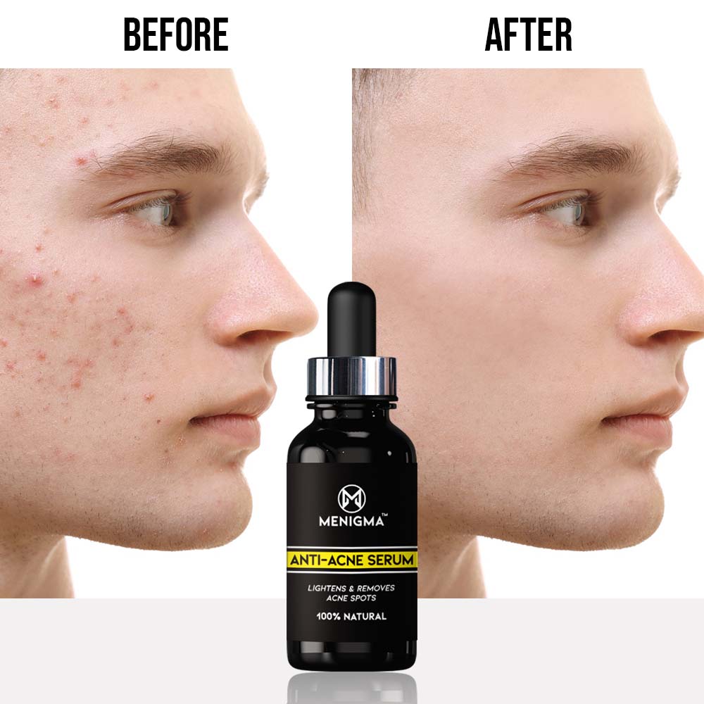 Anti-Acne Serum